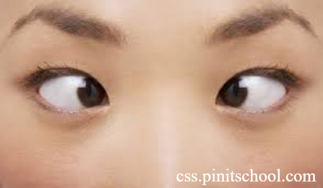 Kenali Penyebab dan Sejumlah Faktor Risiko Mata Juling